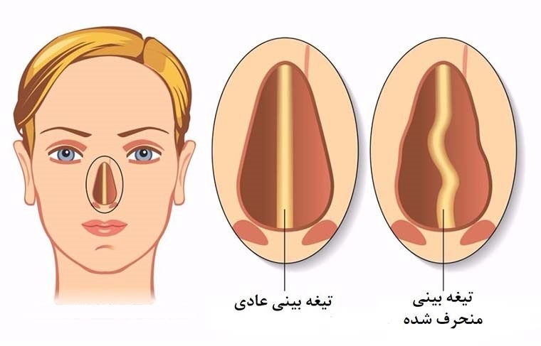 رینوپلاستی چیست