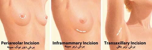انواع و محل برش ها در جراحی زیبایی سینه