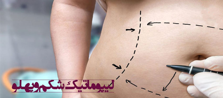 لیپوماتیک شکم و پهلو