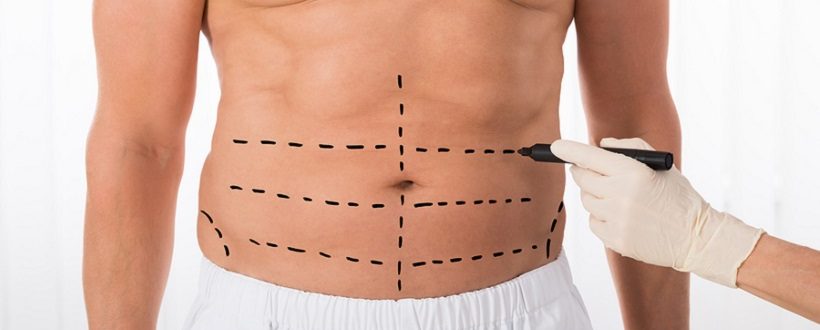 عوارض ابدومینوپلاستی