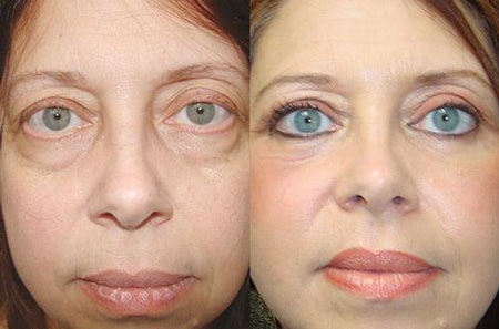 نمونه کار تزریق فیلر زیر چشم