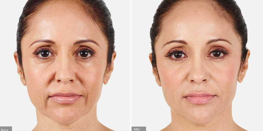 فیلر برای چه قسمت هایی استفاده میشود