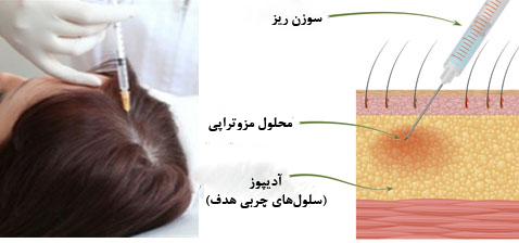 مزوتراپی مو
