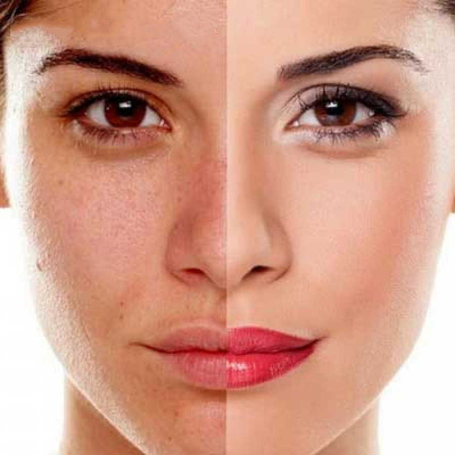 کاربرد میکرودرم ابریژن
