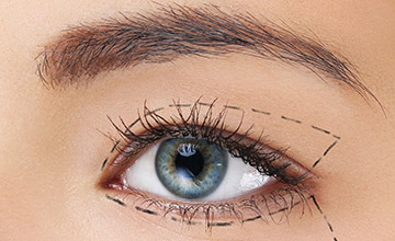 روش های جراحی پلک