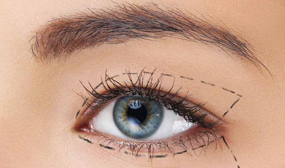 روش های جراحی پلک