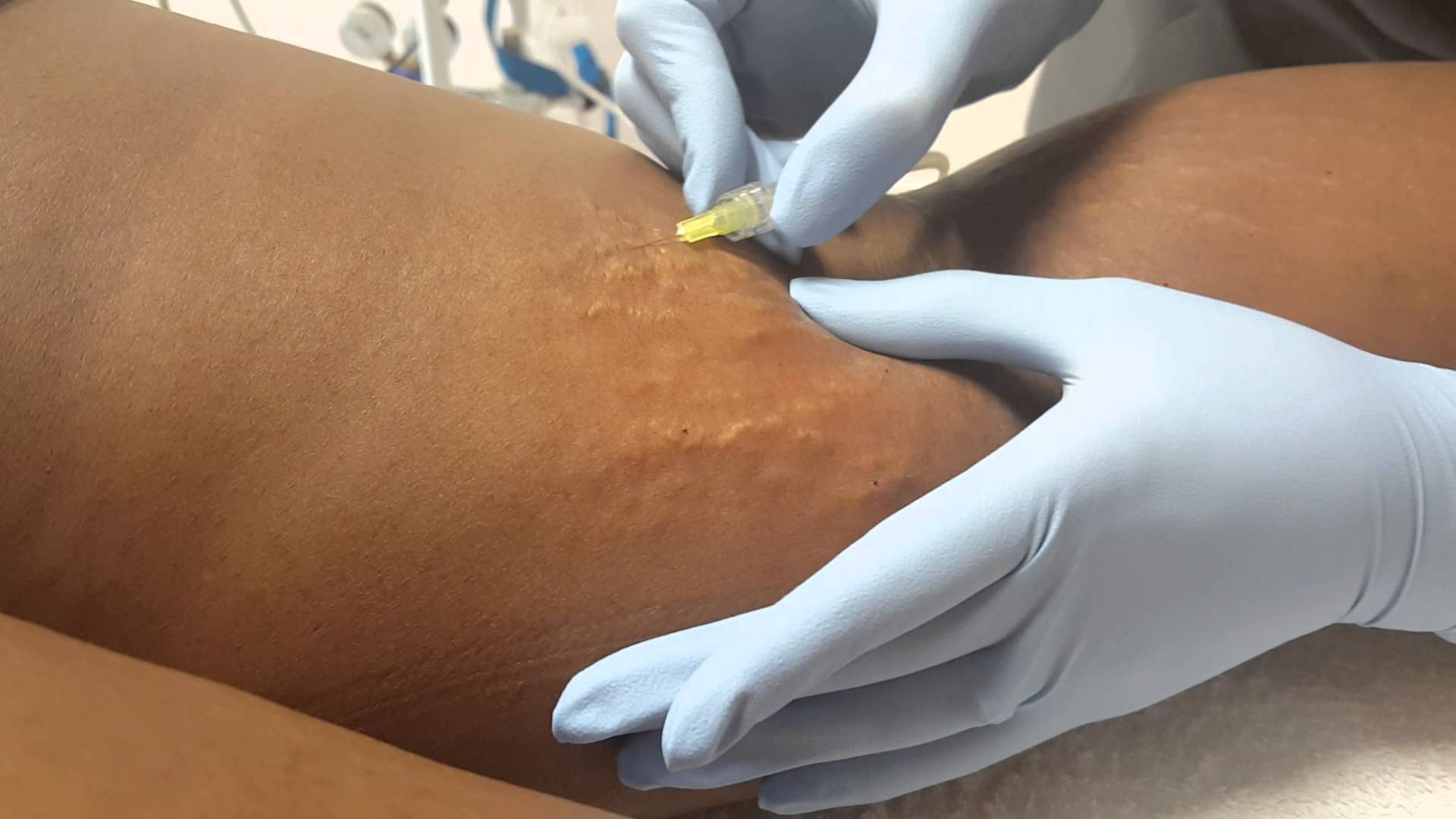 کربوکسی تراپی