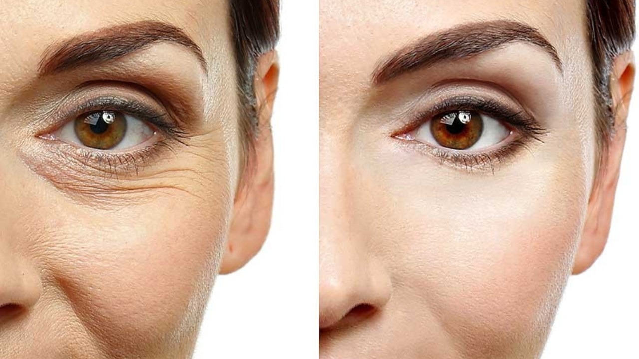 کربوکسی تراپی چیست؟ 