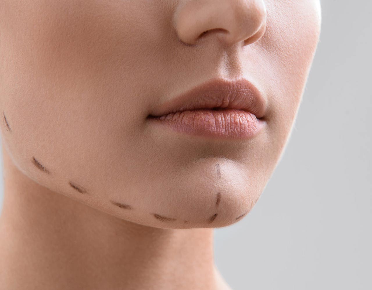 سوالات متداول پروتز چانه