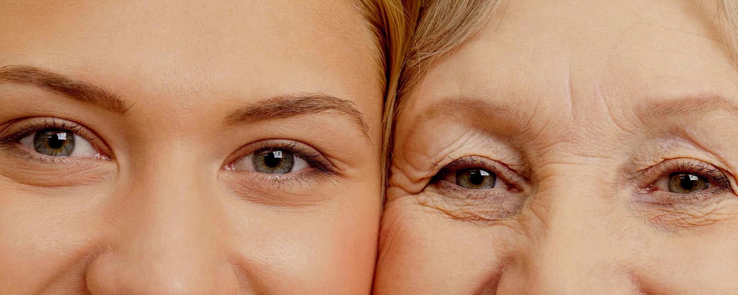 بوتاکس دور چشم